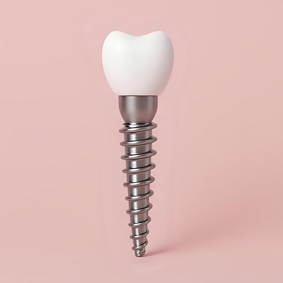 Dental Implants