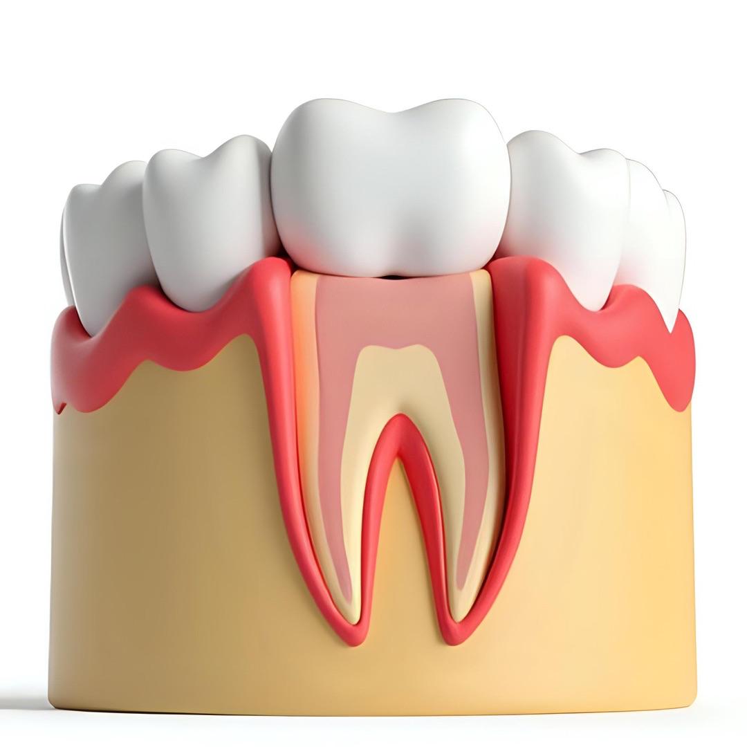 Tooth-Coloured Fillings